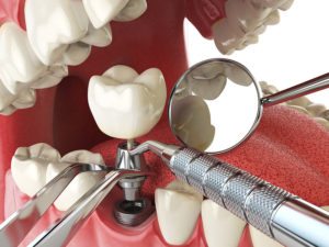 Dental crown installation procedure