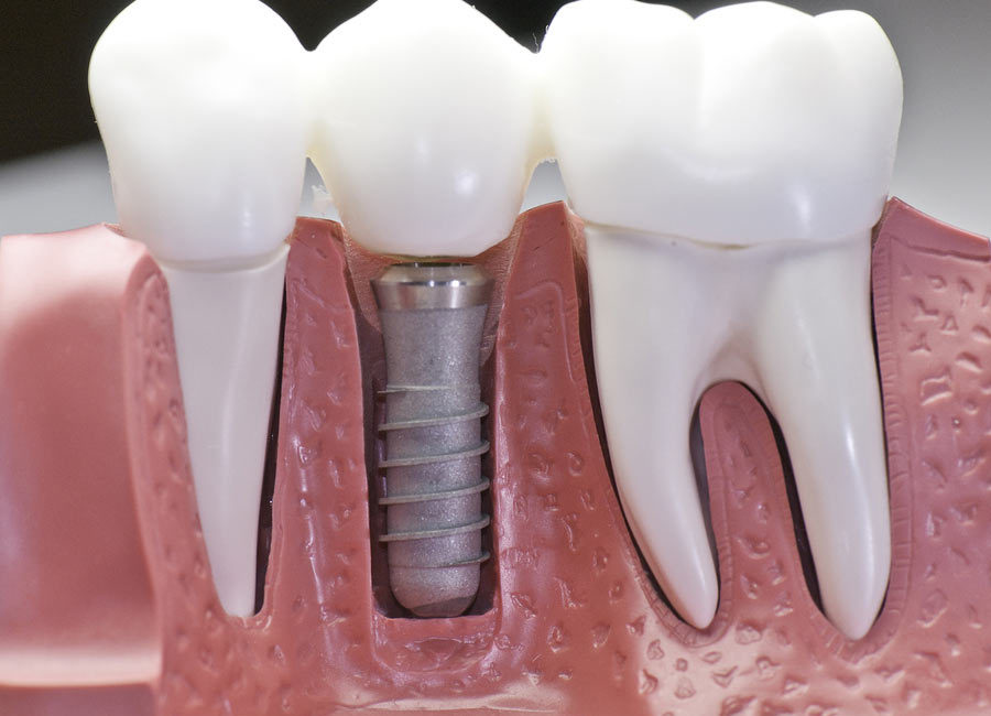 Dental implant model between regular teeth