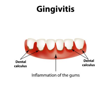 Gingivitis diagram
