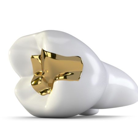 graphic image of tooth with gold filling