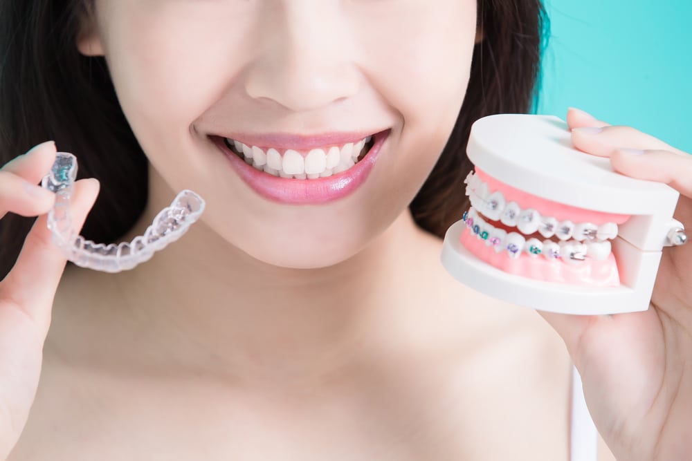 Invisalign Vs Braces: Which One Is Better?