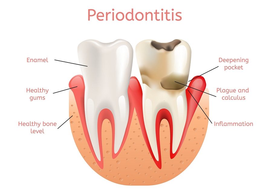 Side by side comparison of a healthy tooth and a tooth having Periodontitis