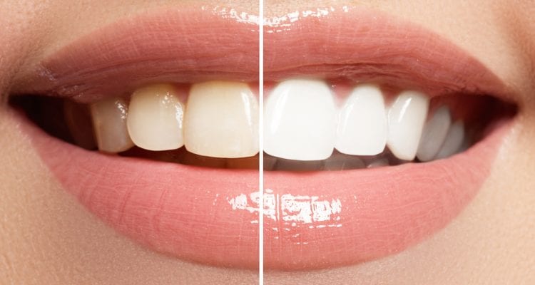 Perfect smile before and after bleaching. Dental care and whitening teeth