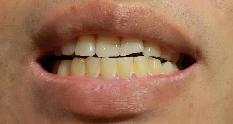 Bacterial plaque on teeth