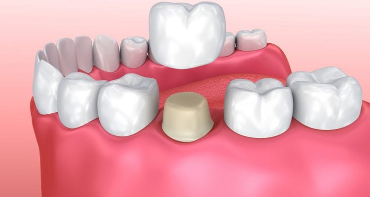 Dental crown installation process, Medically accurate 3d illustration