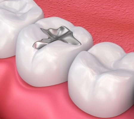 Metal dental fillings, medically accurate 3D illustration