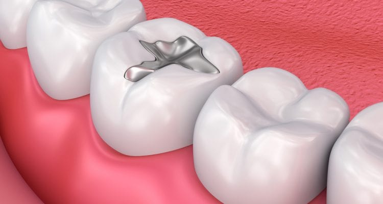Metal dental fillings, medically accurate 3D illustration