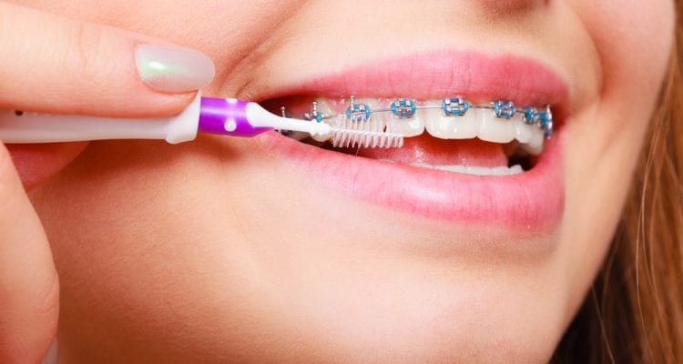 Dentist and orthodontist concept. Young woman cleaning and brushing teeth with blue braces using toothbrush