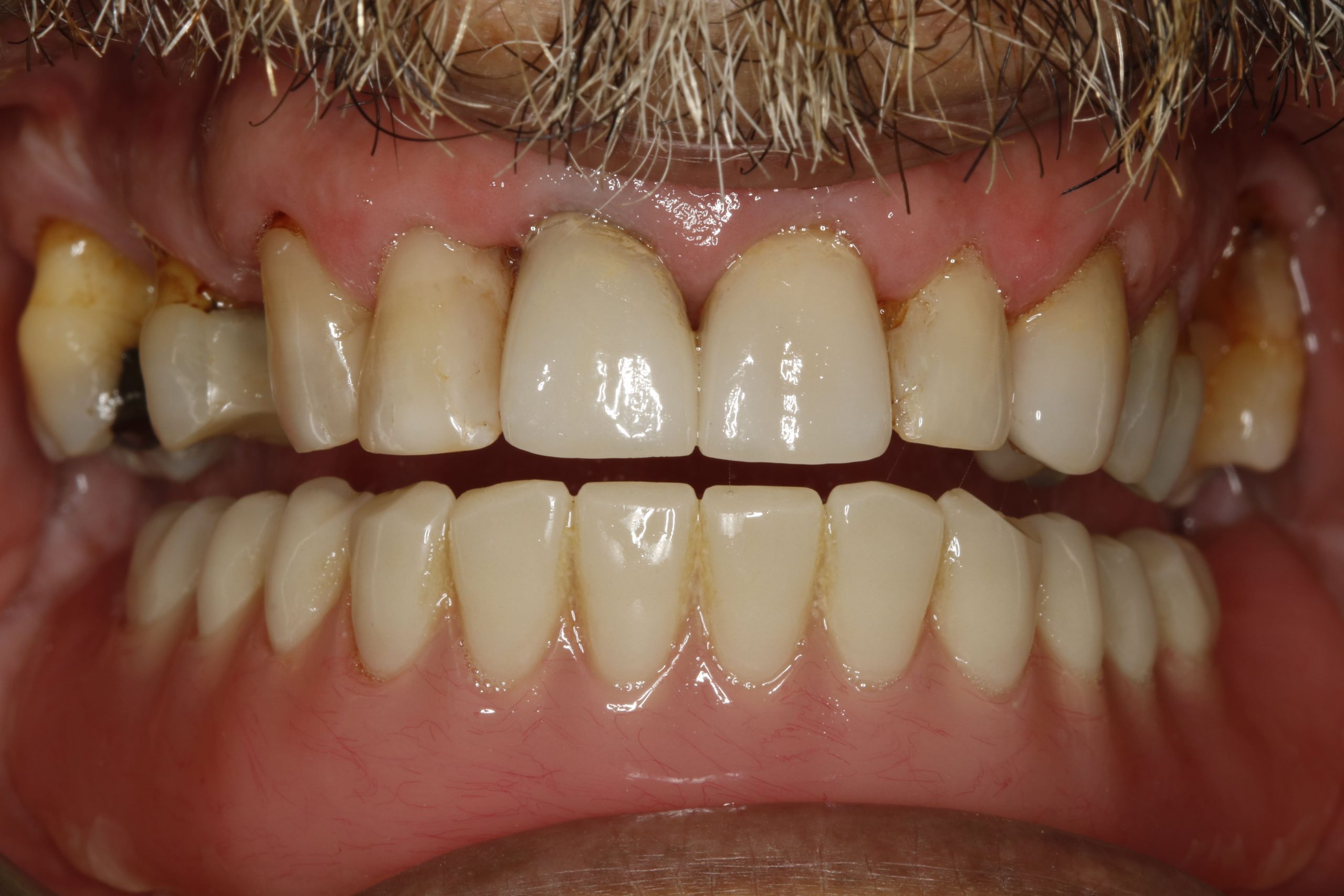 After retracted smile with Crowns, composite fillings and lower denture.