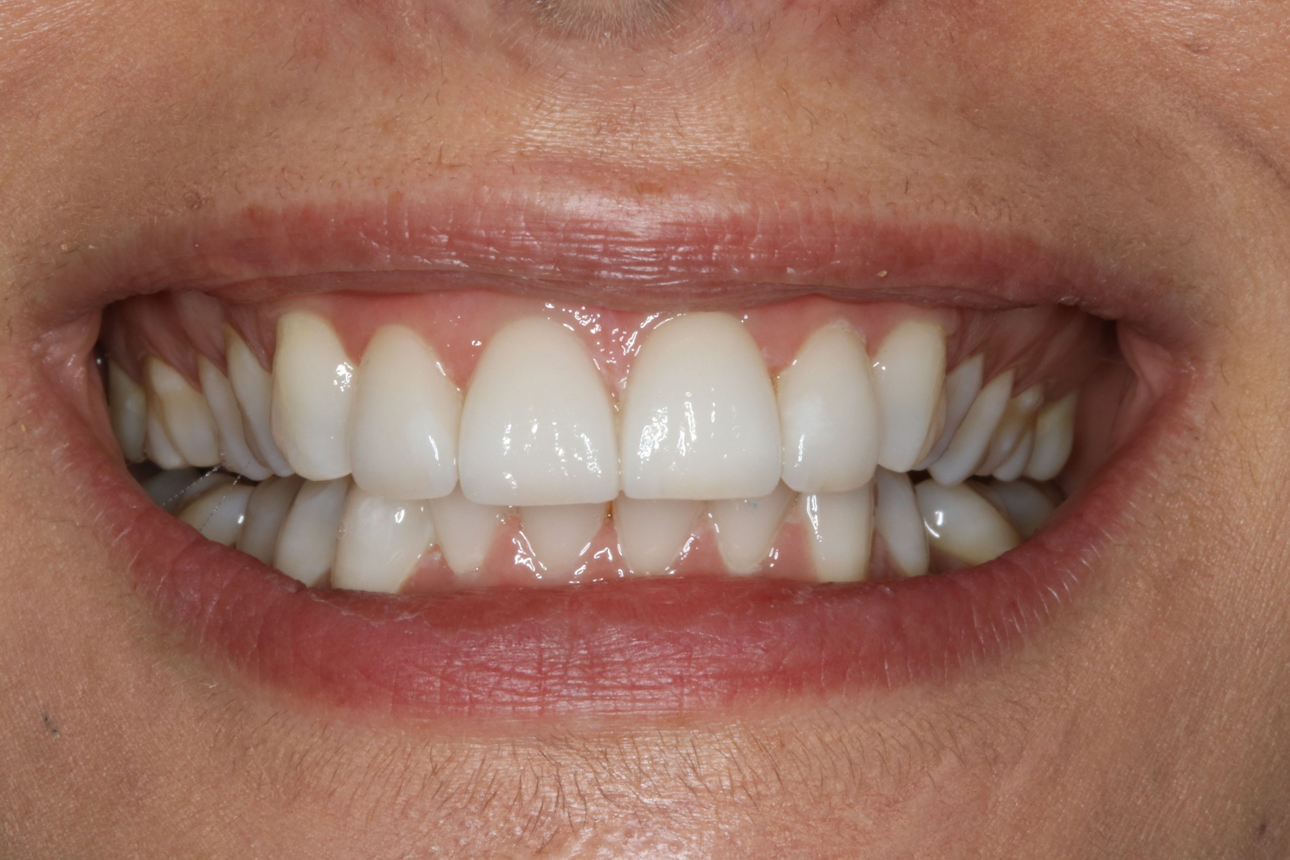 After smile with whitening and veneers