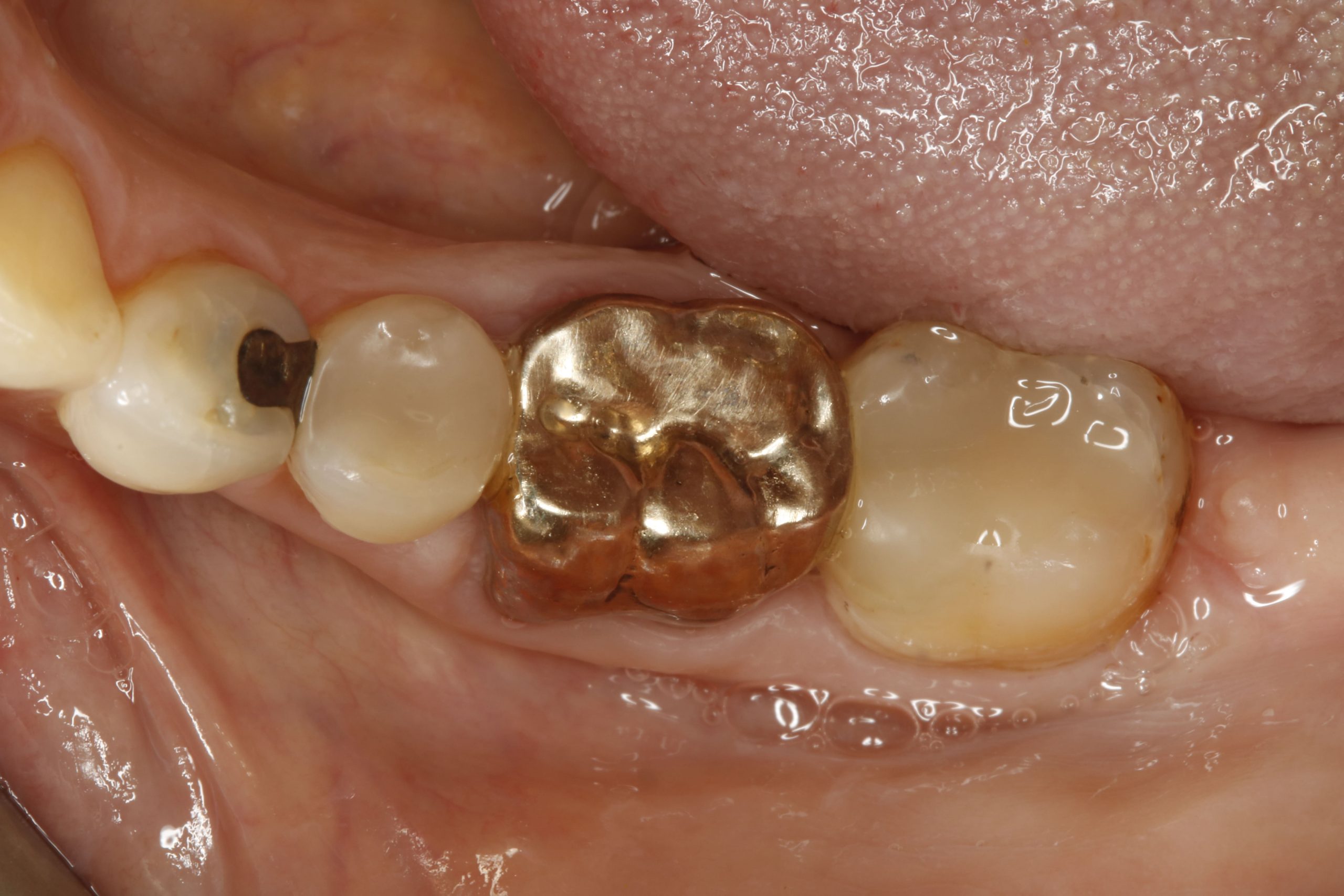 Lower left after, 1 gold crown, 2 white fillings