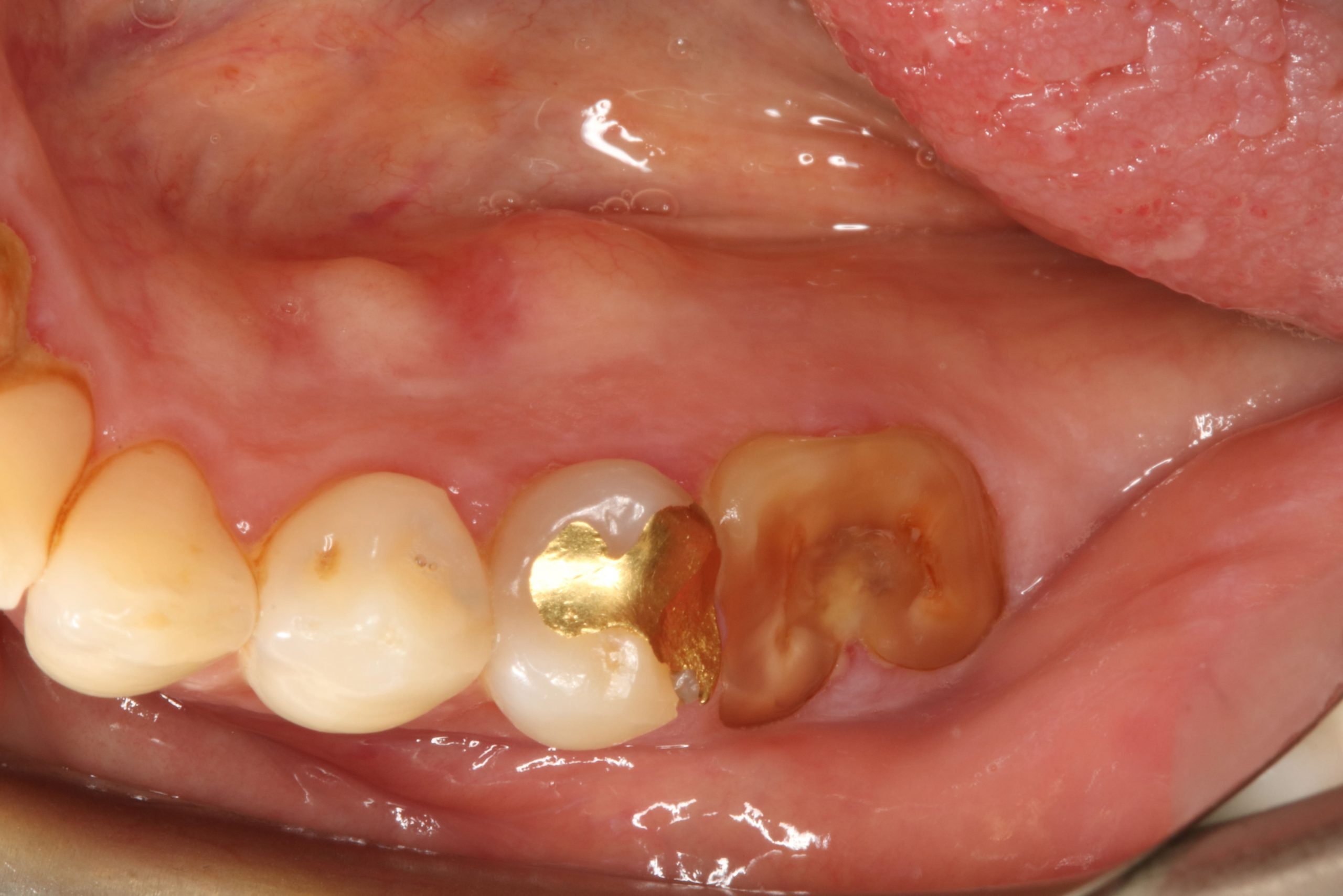Lower left teeth before - Uk 5 Implants