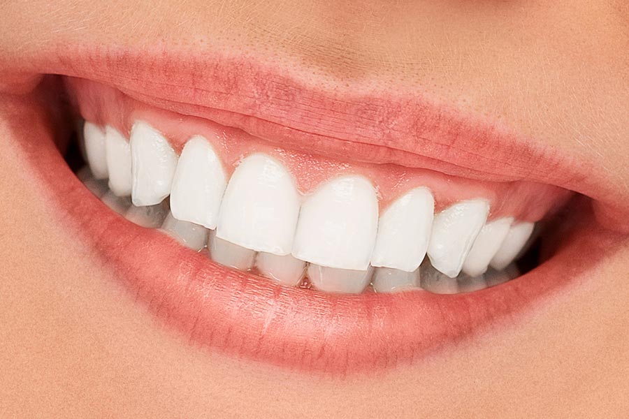 Teeth Fillings for Dental Caries