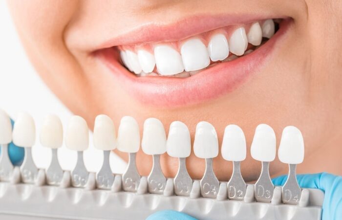 Woman smiling while having teeth colour matched.